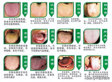 舌頭長痣看哪一科